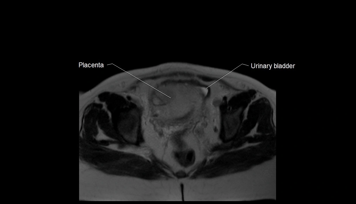 MRI fetal anatomy axial image 36.webp